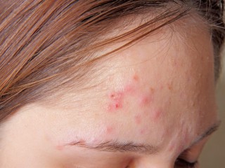 MỤN TRỨNG CÁ – NỖI ÁM ẢNH VÌ LÀN DA XẤU XÍ